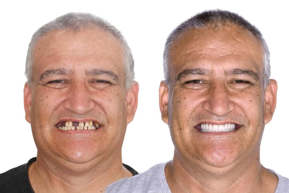Dental Insurance for Seniors with Dentures in Australia